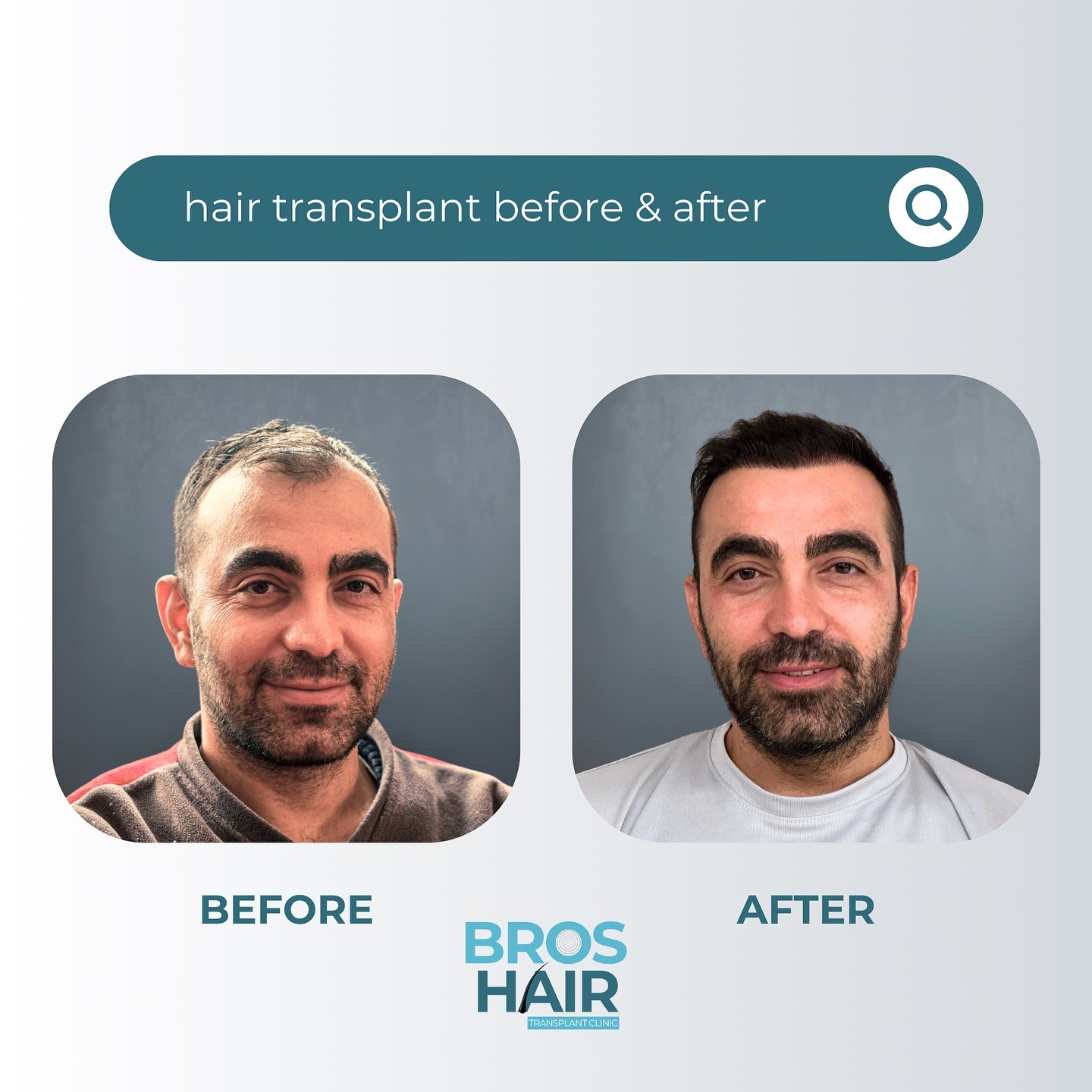 Saç Mezoterapisi Hair Mesotherapy