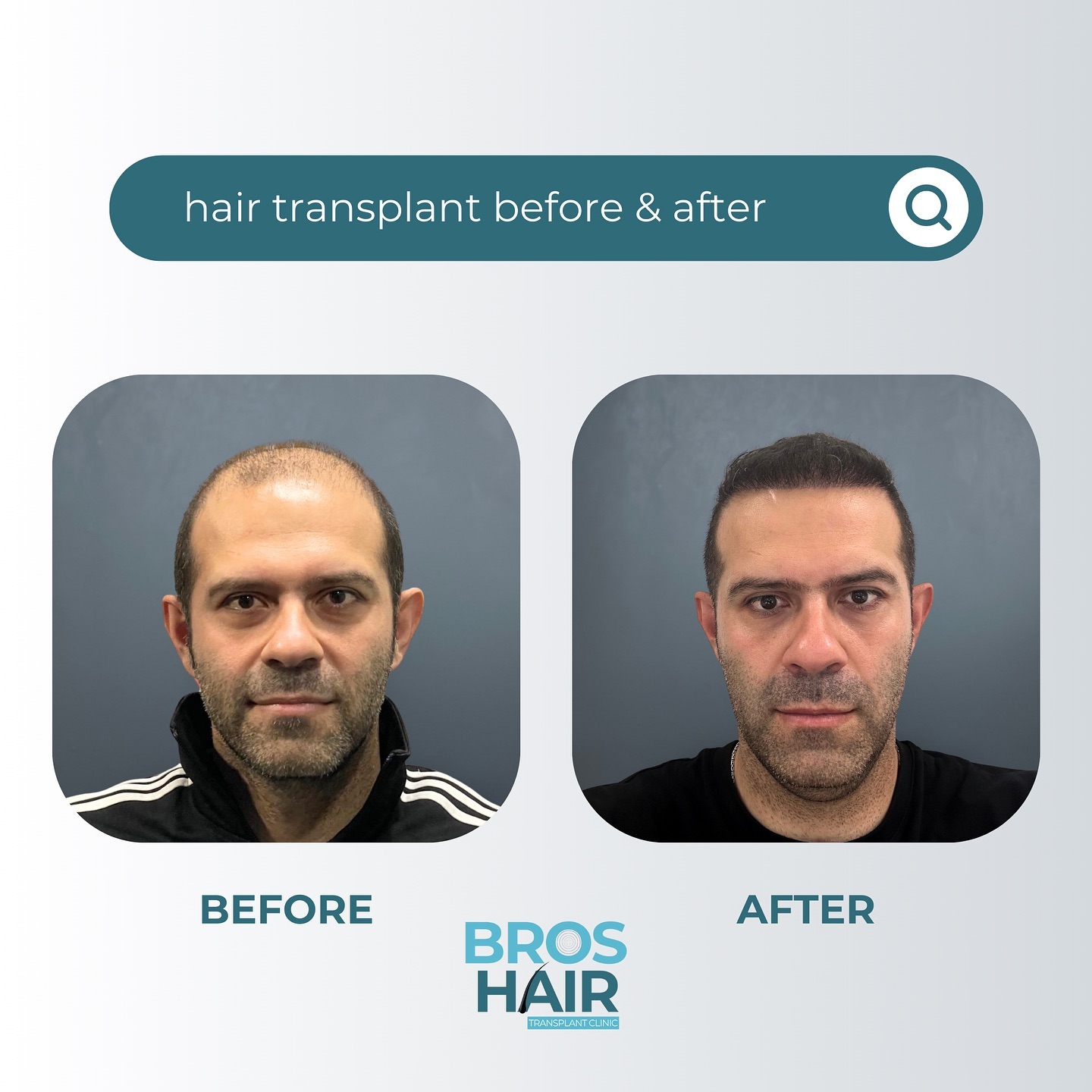 After Hair Transplant Saç Ekimi Sonrası