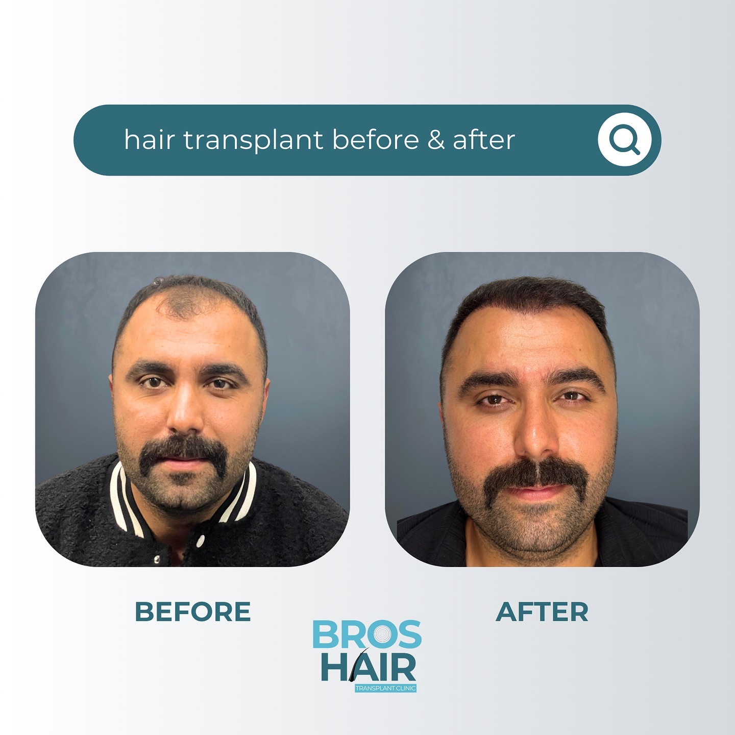 PRP Destekli Saç Ekimi PRP Assisted Hair Transplantation