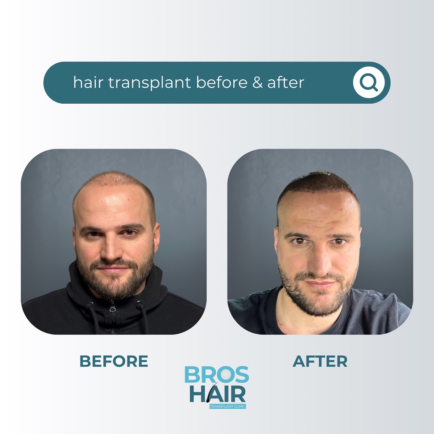 Saç Analizi Hair Analysis