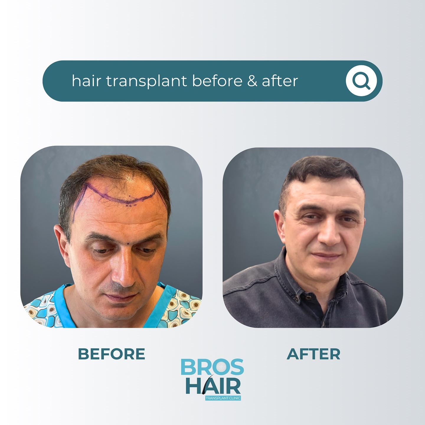 Saç Ekimi Operasyonu Hair Transplant Operation