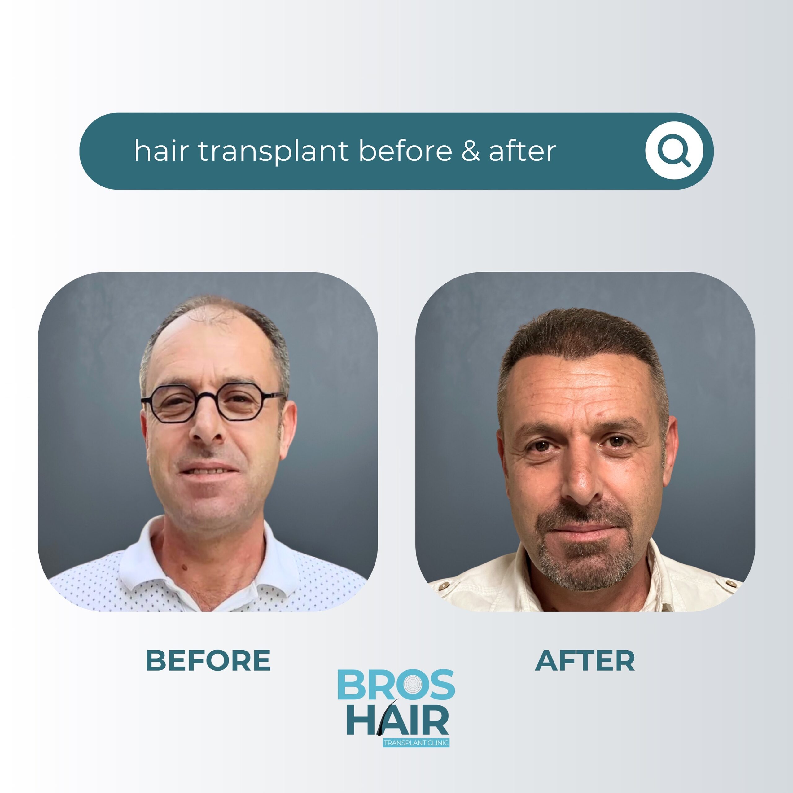 Saç Ekim Gerçekleri Hair Transplant Facts