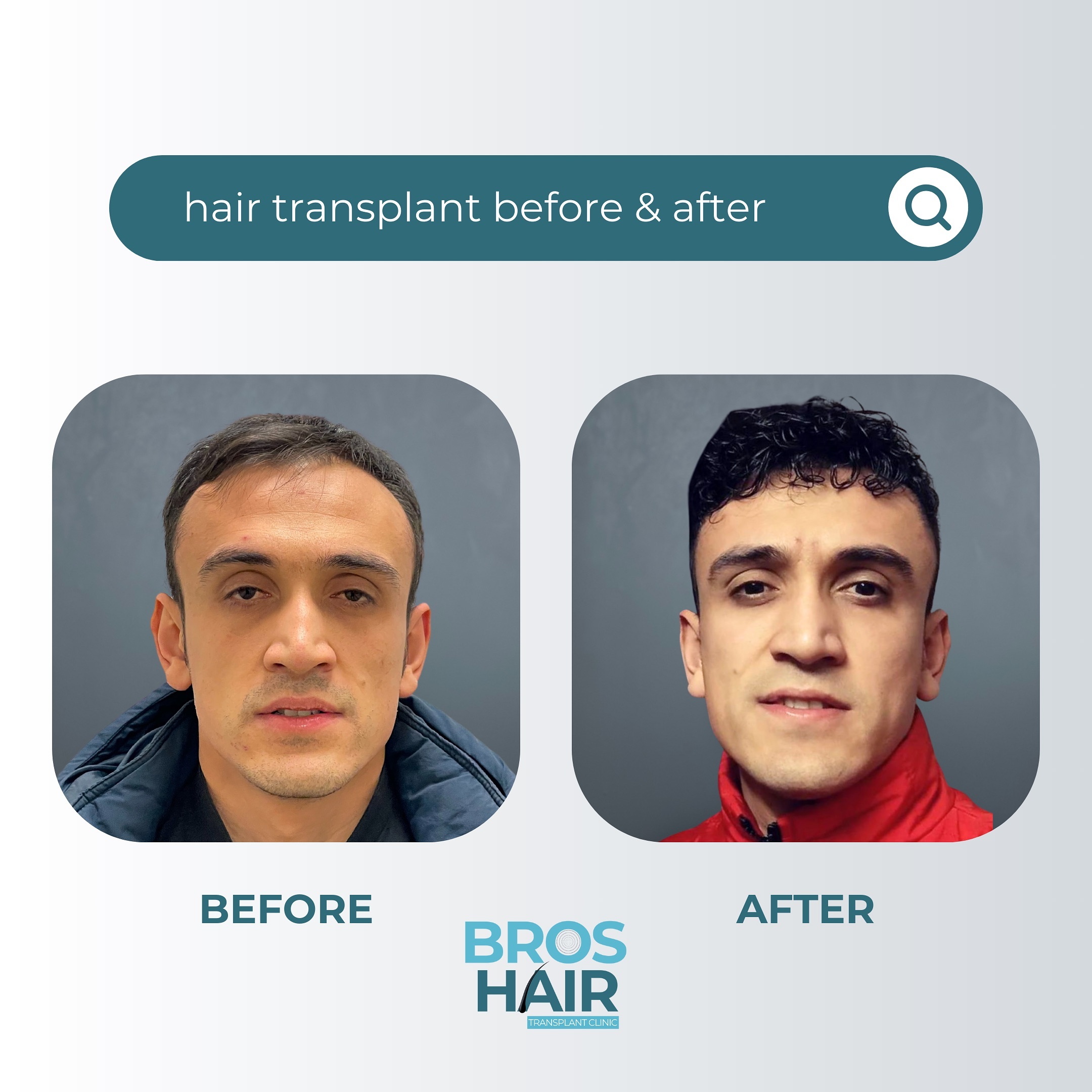 Tıraşsız Saç Ekimi Shaveless Hair Transplant