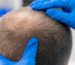 Does a Hair Transplant Hurt Saç Ekimi Sırasında Ağrı Hissedilir mi? İşlem Detayları