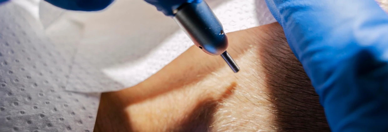 DHI Tekniği (Direct Hair Implantation): Avantajları, Dezavantajları ve İdeal Kullanım Alanları