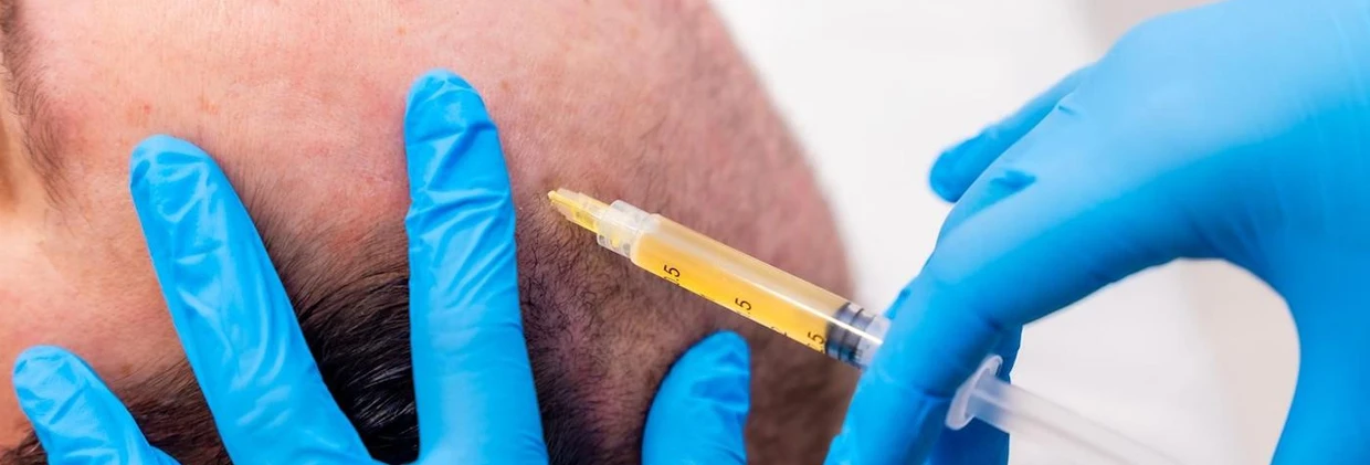 PRP Saç Ekimi Arasındaki Zamanlama: Ne Zaman Uygulanmalı?