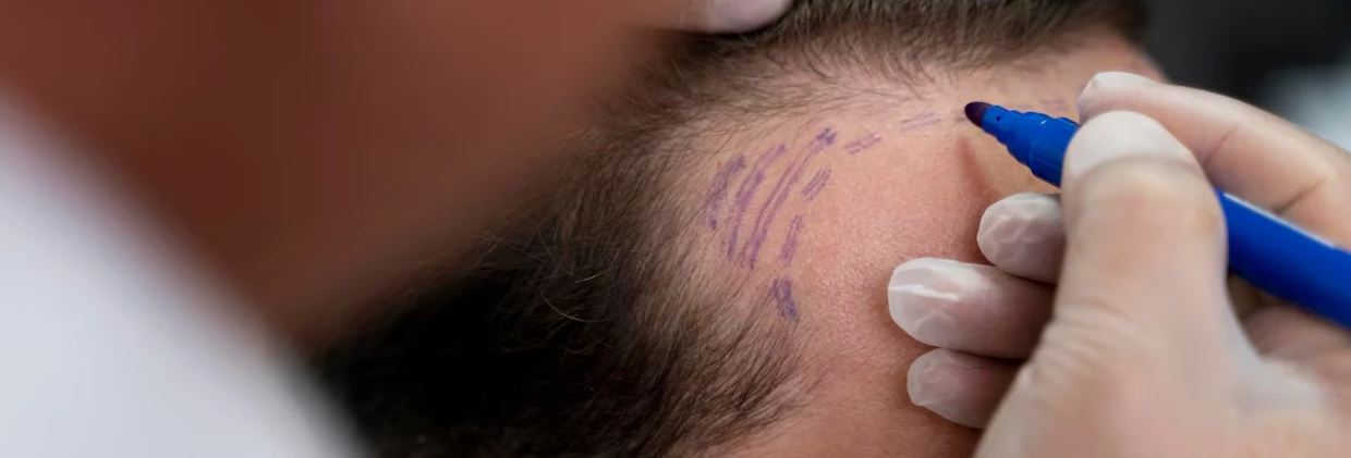 Eksozom Terapisi ile Saç Yenileme