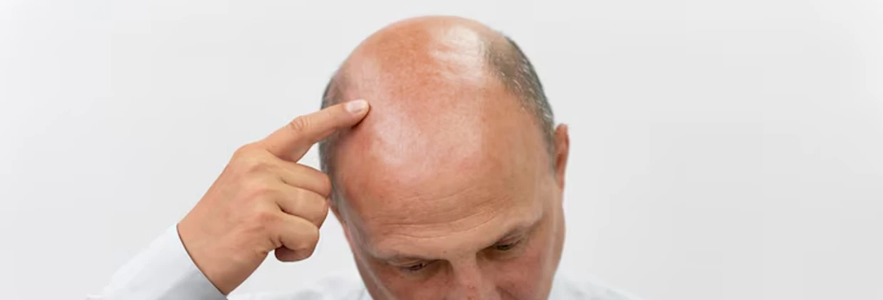 FUE Transplant ile DHI Transplant Arasındaki Farklar: Hangisi Size Uygun?