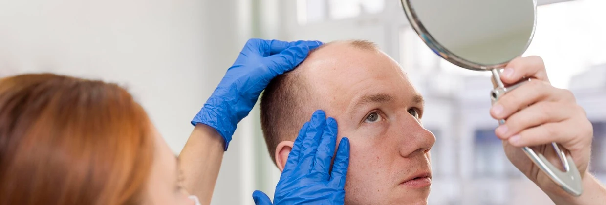 FUE Saç Ekimi Nedir? Aşamalar, Avantajlar, Sonuçlar